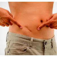 die Blinddarmentzündung